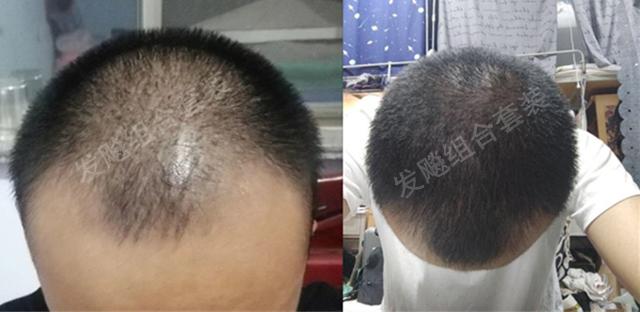 治愈脫發(fā)最新重大突破，重塑自信，希望之光再現(xiàn)