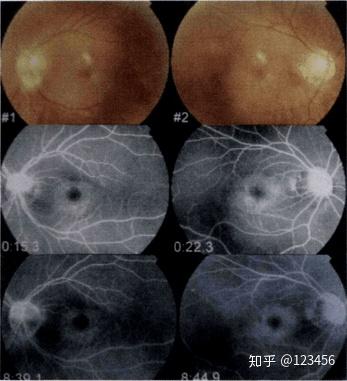 最新藥肺炎詳解，你需要知道的一切——健康小紅書
